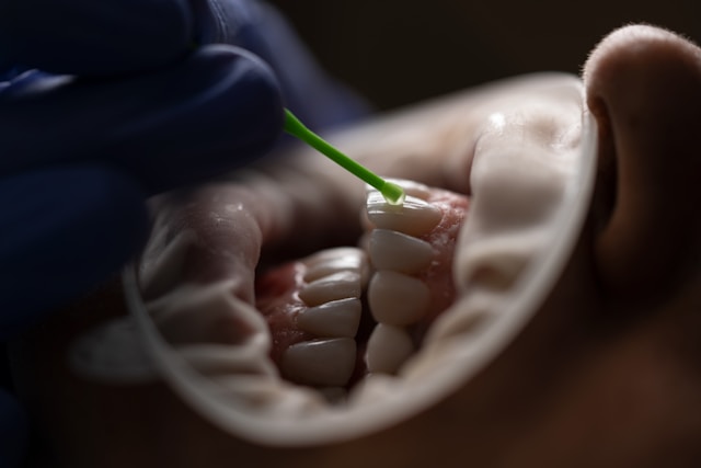 Veneers